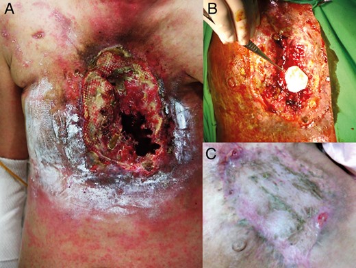 ( A ) The large anterior chest wall wound with necrosis and destruction of the sternum and anterior mediastinum. ( B ) The right ventricular wall defect was repaired with a bovine pericardial patch without cardiopulmonary bypass. ( C ) The anterior chest wall healed after covering it with a myocutaneous flap and intensive wound care.