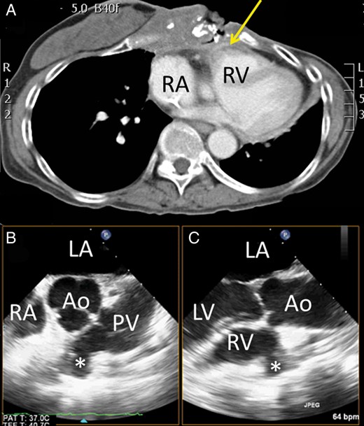 ( A ) Computed tomography showed a fistula (arrow) at the anterior right ventricular outflow tract with the halo sign, which suggested recent bleeding. ( B ) Transoesophageal echocardiography (TOE) showed a fistula (asterisk) at the right ventricular outflow tract in the biplane view. LA: left atrium; RA: right atrium; Ao: aorta; PV: pulmonary valve; LV: left ventricle.
