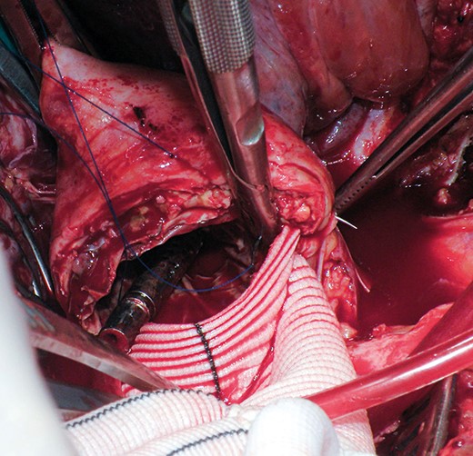 Intraoperative picture of the proximal anastomosis including the native aortic wall, the stent graft and the surgical graft.