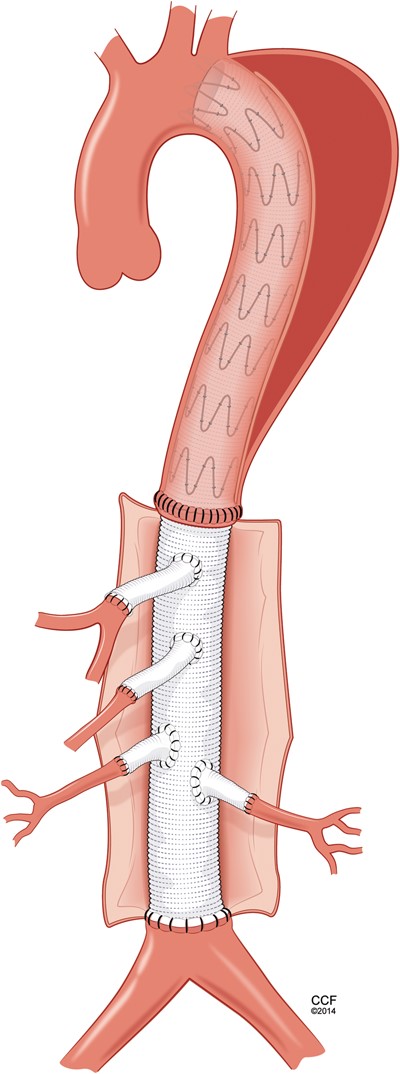 Illustration demonstrating the complete repair.