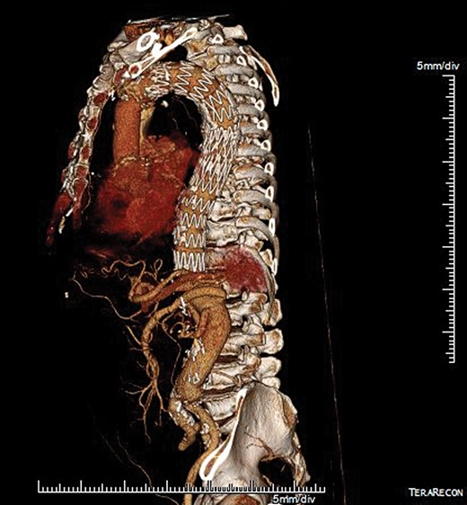 Postoperative 3D multiplanar reconstruction showing the hybrid extensive repair with an endovascular device in the descending aorta and the Dacron graft down to the aortic bifurcation.