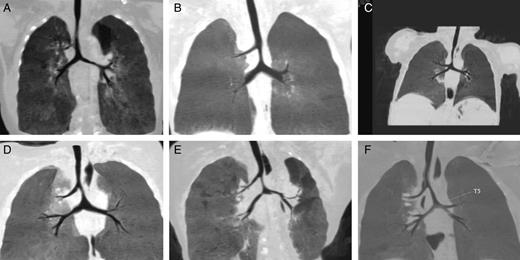The tracheobronchial morphology of the patients. ( A ) Main tracheal stenosis above the RULB. ( B ) Main tracheal stenosis between the RULB and the carina. ( C ) Main tracheal stenosis associated with carina trifurcation. ( D ) Long-segment main tracheal stenosis above the RULB to the carina. ( E ) Tracheal bronchus associated with tracheal and main bronchus stenosis. ( F ) Bridging bronchus associated with main tracheal and intermediate bronchus stenosis. RULB: right upper lobe bronchus.