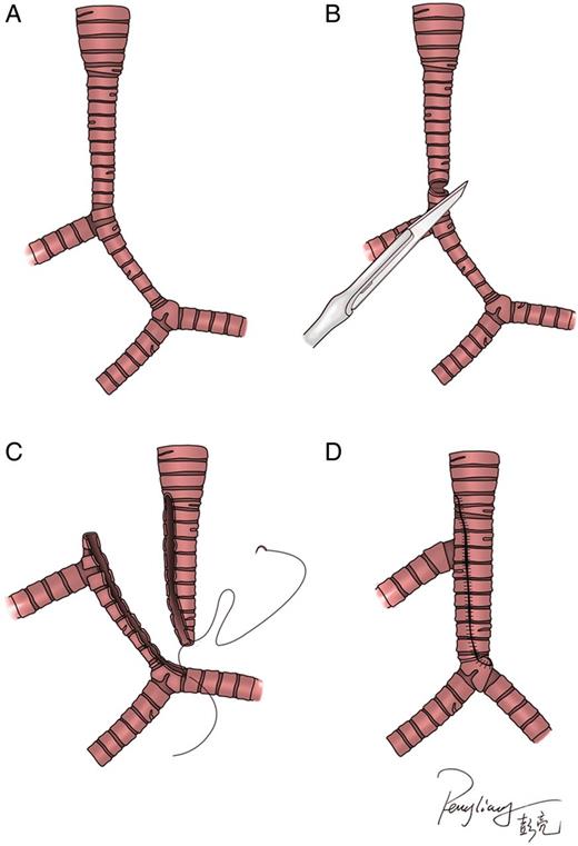 Side-slide tracheoplasty. ( A ) Patient with bridging bronchus associated with main tracheal and intermediate bronchus stenosis. ( B ) The trachea was transected at the mid-level of the stenotic segment. ( C ) Longitudinal incisions were made on the left side of the tracheal segment opposite the side of the orifice of the RULB and on the right side of another tracheal segment. ( D ) A sliding oblique anastomosis was performed with running polydioxanone suture without compromising the orifice of the RULB. RULB: right upper lobe bronchus.