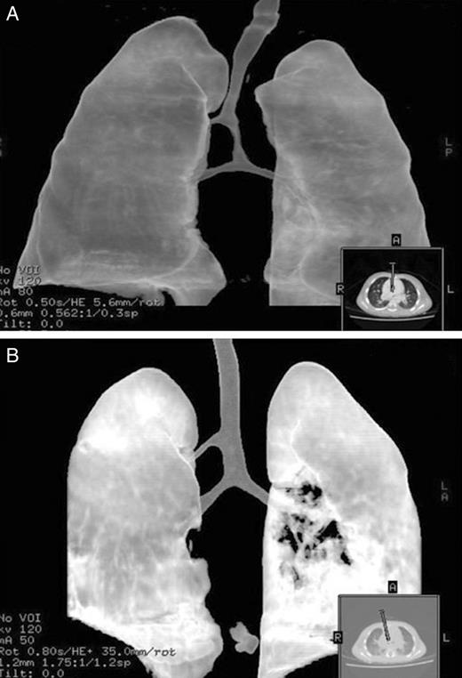 CT scan showing tracheal morphology before and after side-slide tracheoplasty. ( A ) Preoperative CT scan showing a bridging bronchus associated with main tracheal and intermediate bronchus stenosis. ( B ) Four months after side-slide tracheoplasty, CT scan showing clear improvement of the tracheal morphology. RULB: right upper lobe bronchus; CT: computed tomography.