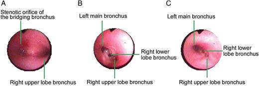 Intraoperative and postoperative bronchoscopic view. ( A ) Bronchoscopic view before operation. ( B ) Intraoperative bronchoscopic view after everting suture demonstrating the satisfactory luminal area without any ridges of cartilage inserted into the lumen. ( C ) Follow-up bronchoscopic view 1 month after the operation demonstrating a satisfactory appearance without evidence of granulation tissue.
