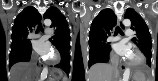 Computed tomography scan showing massive, horseshoe-shaped mitral annular calcification. White arrows indicate mitral annular calcification. ( A ) Preoperative computed tomography image (coronal view). ( B ) Postoperative computed tomography image (coronal view).
