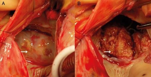 Intraoperative photos of mitral annular calcification. White arrows indicate mitral annular calcification. ( A ) Calcified matter had comprehensively invaded the posterior mitral annulus extending to the anterior and posterior commissures, the posterior leaflet and the atrial and ventricular walls. ( B ) After incision of the endocardium of the posterior mitral annulus with a surgical knife.