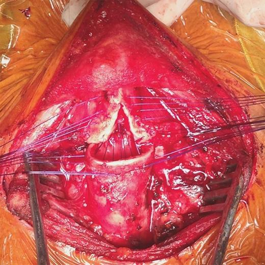 Intraoperative view of thyrotracheal anastomosis after cricotracheal resection with partial laryngofissure for idiopathic stenosis involving the vocal cords. Interrupted sutures have been placed but are still untied.