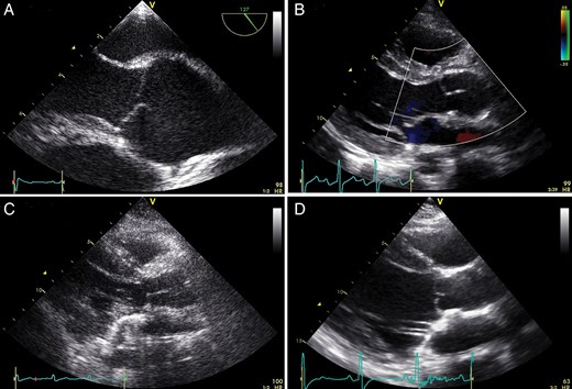 A + B : typical preoperative ( A ) and postoperative ( B ) echocardiographic image of a Marfan patient (14 years old, root diameter 46 mm, z -score +5, 28 mm Valsalva prosthesis, no AR). Note in echo B how root geometry is restored with the technique. There is a large coaptation height as well as effective height and no billowing or prolapse. C + D : echo images of the patient that developed Grade 3 AR, 4 years after the initial valve-sparing root replacement with plication of the non-coronary cusp (14 years old, root diameter 41 mm, z-score +2.9, 28 mm Valsalva prosthesis). ( C ) Postoperative echo after the initial operation with no prolapse of the cusps and no AR. ( D ) The echo image 4 years thereafter shows some billowing/prolapse of the cusps (and a Grade 3 excentric AR that cannot be seen on this echo still). Please note the smallish coaptation and effective height. Patient underwent a Bentall procedure. AR: aortic valve regurgitation.