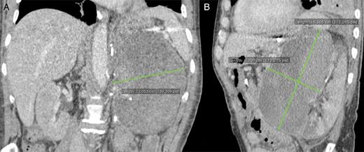 Contrasted abdominal computed tomography showing the voluminous left adrenal tumour.
