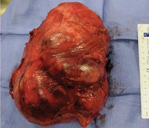 Complete resection of the voluminous multilobar tumour (19 × 17 × 12.5 cm, 1754 kg) has been successfully performed by open surgery under protective extracorporeal life support device. Pheochromocytoma was confirmed by histological analysis with intense chromogranine A and synaptophysin immunolabelling.