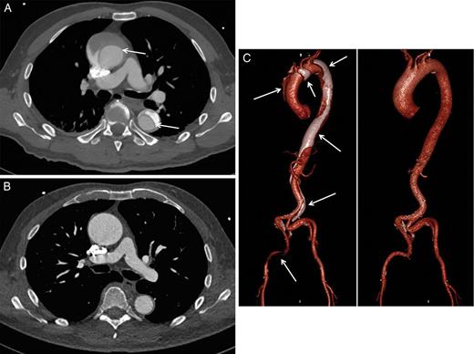 ( A ) Acute type A aortic dissection (white arrows). ( B ) One-year follow-up with complete remodelling. ( C ) 3D reconstruction of acute dissection (white arrows) and remodelling.