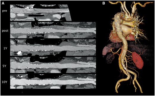 3D-multiplanar reconstruction (A) analysis illustrates the durable aortic treatment combined with positive remodelling in acute aortic dissection 10 years after implantation of the E-vita Open stent graft (B).