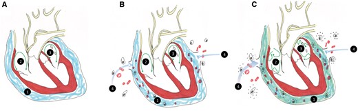 A (1) Pericardial fluid (blue) bathes the normal heart including the (2) right and (3) left atria. Green arrows represent atrial conduction. B Surgery disrupts the pericardium and blood and inflammatory cells enter the pericardial space (4). C (1) Pericardial fluid composition now includes inflammatory cells, cytokines, and highly oxidative proteins, causing atrial fibrillation (green arrows).