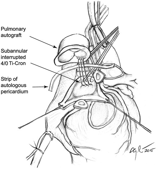 Illustration of the subannular implantation technique as it is performed at the Great Ormond Street Hospital, London, UK. Interrupted 4/0 Ti-Cron sutures are used to position the pulmonary autograft within the left ventricular outflow tract. A single pericardial strip is used as a tissue buffer to improve haemostasis of the proximal anastomosis.