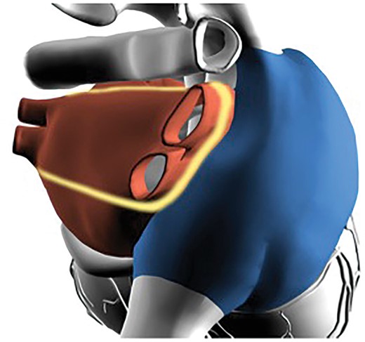 Epicardial left atrium ‘box lesion’ set.