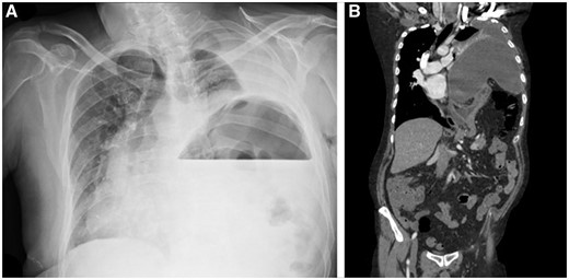 Preoperative images. X-rays showed a possible diagnosis of intrathoracic stomach in a 53-year-old man with dystonia, dysphagia and dyspnoea (Fig. 1A). Computed tomography scan demonstrated a large relaxation of the left diaphragm with the lung reduced to a small fist (Fig. 1B). A left thoracotomy was performed. A patch was used to reinforce the diaphragm. The patient is well at 2-year follow-up.
