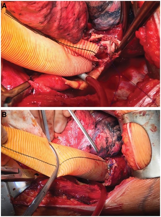 Open surgical extension of a frozen elephant trunk with a Dacron graft prosthesis. (A) The distal part of a Vascutek Thoraflex hybrid prosthesis is shown. We usually remove the last stent ring to facilitate the anastomosis. (B) The anastomosis between the stent graft portion and a straight-tube Dacron graft is shown.