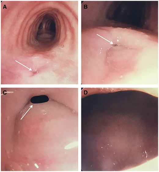 Preoperative bronchoscopy for Patient 5. Bronchoscopy demonstrated a mid-tracheal mucosal defect in the membranous trachea (arrow) (A). High magnification bronchoscopy of the membranous trachea further demonstrated the defect (arrow) (B). Bronchoscopic advancement to the area of the defect begins to highlight the TEF (arrow) (C). Further advancement to the area of concern allows direct visualization of the oesophageal lumen from the trachea and confirms the presence of TEF (D).