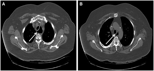 Chest computed tomography for Patient 7. Selected images demonstrate proximal oesophageal dilation (arrow) (A) with distal recurrent congenital tracheoesophageal fistula (arrow) (B).