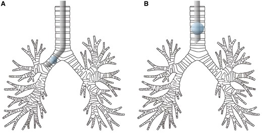 The location of the endotracheal tube for one-lung ventilation (A) and spontaneous ventilation (B).