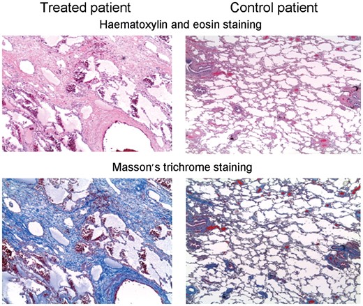 In the chemotherapy group, histological examination of lung parenchyma showed a completely subverted architecture, characterized mainly by a diffuse fibrosing process, particulary around vascular structures and along septa and alveolar–capillary membranes. In some cases, microcystic and emphysematous areas, in a likely honeycombing pattern, were evident. Fibrosis was more evident following Masson’s trichrome staining.