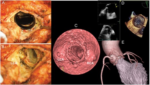 Pannus did not interrupt the valve (A). The pannus was revealed after taking the aortic valve with the narrowing of the outflow tract (B). Virtual angioscopy with multidetector computed tomography detected the pannus at the subvalvular position (C), which was difficult to detect by fluoroscopy, transoesophageal echocardiography (D) and 3D computed tomography (E). LCA: left coronary artery; RCA: right coronary artery.