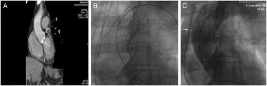 (A) Preoperative computed tomography scan showing the extent of the aortic valve calcification (white arrow). (B) Angiographic image. Projection of the valve in valve (ViV) after retrieval back to the ascending aorta. (C) Angiographic image. Projection of the ViV during contrast angiography. The inferior struts of the first implant are shown to penetrate the aortic wall (white arrow).