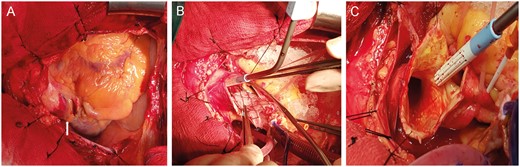 Intraoperative images: surgeon’s view. (A) Haematoma on the ascending aorta after dissection of the pericardium (white arrow). (B) Retrieval of the valve in valve from the ascending aorta. (C) The imprint of the valve skeleton in the aortic intima.
