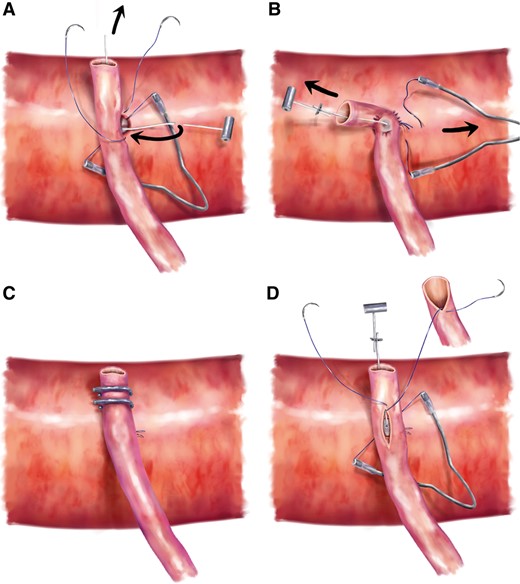 Schematic illustration of the anastomosis steps. (A) The graft is anastomosed to the ascending aorta in a side-to-side manner. Midway through the suturing, the anchor string of the HEARTSTRING is cut and passed inside the graft lumen to the free end. (B) After completion of suturing, the thread is tied. The HEARTSTRING device is removed through the free end of the graft. (C) The free end is ligated twice with medium-sized Hemoclips. The anastomosis is complete. (D) The point of a piggyback anastomosis is shown. The roof of the initially anastomosed graft was incised, and the second graft was anastomosed onto the roof of the primary graft.