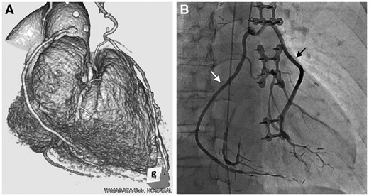(A) Postoperative computed tomographic angiography of radial artery graft and (B) postoperative angiography of saphenous vein grafts anastomosed in a piggyback fashion are shown. White arrow indicates a graft to right coronary artery and black arrow indicates a graft to the circumflex artery.