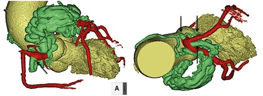 Computed tomography showing coronary artery fistulas to pulmonary artery originating from the right coronary, the left main trunk and the circumflex arteries (arrows).