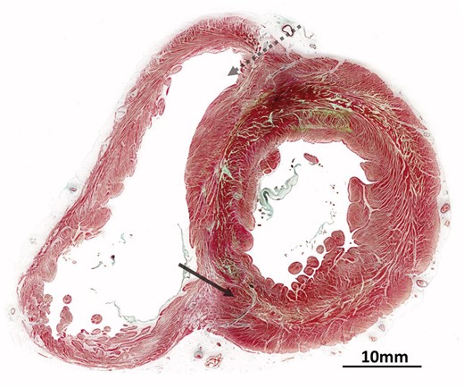 Microscopic anatomy of the human heart. Cross-section of human heart at the equator stained using Masson’s trichrome technique. The dashed arrow indicates the region where the dissection is performed by Torrent-Guasp damages cardiomyocytes while entering the right ventricle. The solid arrow shows the disruption required within the mid-zone of the circumferentially orientated cells. The presence of aggregated units is evident, forming chevron-like structures around most of the ventricular circumference.
