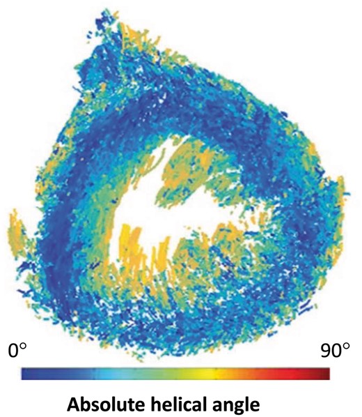 Eigen analysis of the human heart using microcomputed tomography. Angle maps are viewed in short axis, and colour bars indicate cardiomyocyte helical angulation. Note the cardiomyocytes with a helical angle close to zero (blue) encircling the entire circumference of the mid-ventricular wall.