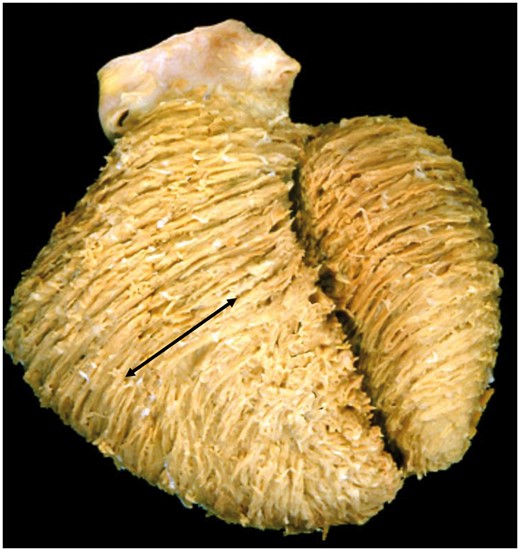 Ventricular architecture in tetralogy of Fallot. The dissection reveals the macroscopic features in the setting of tetralogy of Fallot, showing a middle layer with a circumferential orientation in the right ventricle (arrow). The presence of circumferential cardiomyocytes in a direction perpendicular to the direction of the ‘basal loop’ is incompatible with the concept of a ‘unique myocardial band’.