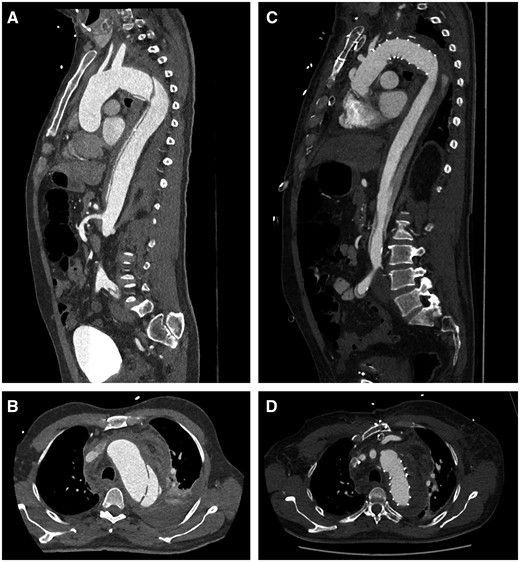 Representative computer tomography scan: sagittal plane view of an acute Stanford Type B aortic dissection with a significant true-lumen collapse (A) and a rupture site causing a left haemothorax (B). Postoperative images following the frozen elephant trunk procedure: a significant true-lumen expansion and almost complete false-lumen thrombosis in the sagittal plane view (C) with successful closure of the entry (D).