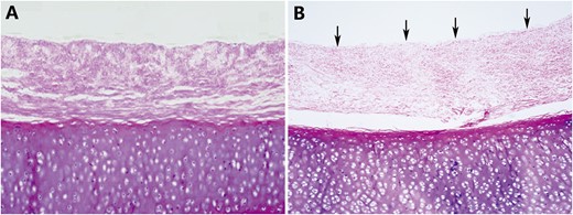 (A) A histological examination showed that the epithelium and mixed glands were completely removed and denuded after detergent treatment. (B) Residual epithelium (arrows) was confirmed in the remaining graft (original magnification ×40).