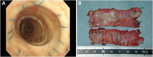 (A) In the allograft from the dog observed for 792 days, the fibre-optic bronchoscopy findings revealed that no stenosis had developed in the shiny inner surface. (B) After harvest, the macroscopic findings revealed that the allograft from the dog observed for 792 days had been incorporated into the host trachea. The luminal surface appeared shiny and patent.