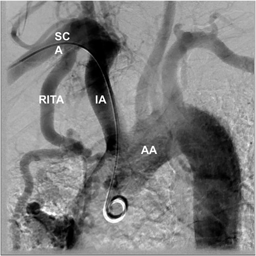 Extended coronary angiogram showing the RITA terminating into the pulmonary vein, SCA, BA and AA. AA: aortic arch; BA: brachiocephalic artery; RITA: right internal thoracic artery; SCA: subclavian artery.
