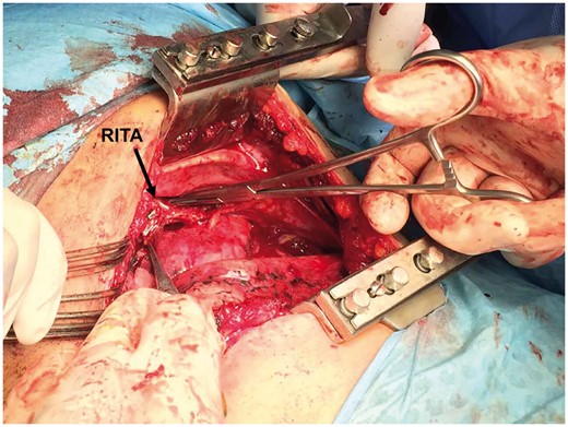 Intraoperative image showing a large RITA. RITA: right internal thoracic artery.