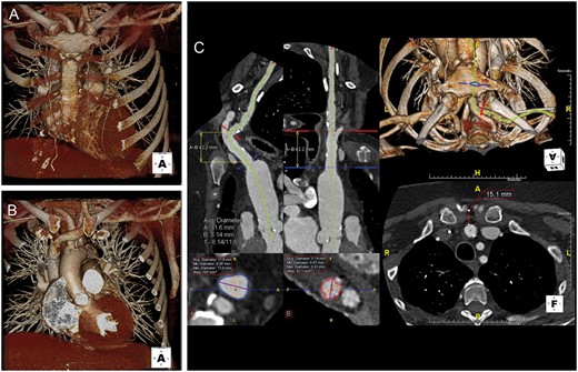 Gated chest computed tomography angiography showing anatomical relations of the innominate artery with surrounding structures. 3D volume-rendered image (A) with and (B) without the sternum. Centre line generation with multiplanar reformation performed to evaluate innominate artery diameter and distance of access to annular plane. (C) Repositioning of 3D reconstruction is performed to mimic intraprocedural position on the table to evaluate the relationship between the innominate artery and the adjacent bony structures and mediastinum.