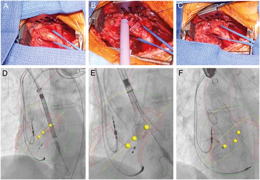 Surgical exposure of the innominate artery via a supraclavicular, parasternal exposure. (A) Insertion of an 18-Fr sheath (Cook Medical) within the 4-0 Prolene-pledgeted purse string. (B) Sheath removed and purse string secured. (C) Computed tomography angiography–fluoroscopy fusion images (HeartNavigator System, Philips Healthcare, Best, Netherlands) with outline of the aorta, innominate artery and coronary arteries identified in red, base of the coronary cusps as yellow dots and annular plane as yellow circle. Medtronic CoreValve THV is identified crossing the aortic valve (D), during partial (E) and final (F) deployment.
