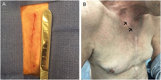 Result after closure of supraclavicular, parasternal incision, intraprocedural (A) and at 3-month follow-up (B).