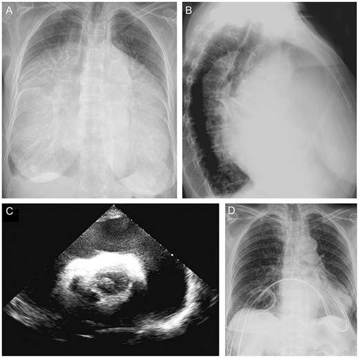 A healthy 79-year-old woman presented with cachexia, progressive dysphagia and dyspnoea (New York Heart Association Class III) over 4 weeks. (A and B) Chest X-ray. (C) Echocardiogram. (D) After drainage through the right fifth intercostal space and creating a pericardopleural window, symptoms resolved completely. Extensive workup did not show any aetiology. Very rarely, dysphagia can be a sign of a pericardial disease.