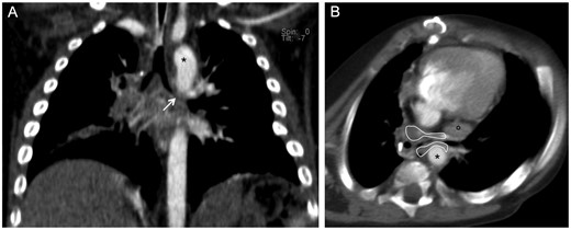 Computed tomographic angiography in Patient 1. (A) Multiplanar coronal reconstruction: severe malacia involving the left mainstem bronchus (white arrow). (B) Axial plane: the left mainstem bronchus lies close to the descending aorta (*) and left pulmonary artery (°) with peribronchial fibrous tissue (area enclosed by the continuous white line) causing severe bronchial narrowing.