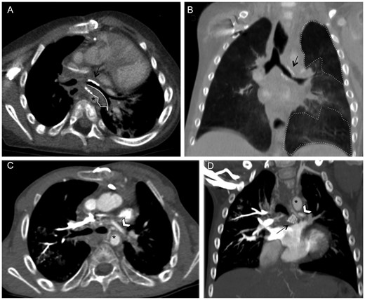 Computed tomographic angiography in Patient 2. (A) Axial plane: abnormal stent dilatation (black arrow) in the left mainstem bronchus with endobronchial and peribronchial fibrous tissue (area enclosed by the continuous white line) causing the bronchial stent to lie close to the centrally positioned descending aorta (*). (B) Coronal plane, minimum intensity projection reconstruction: stent deformation with severe bronchial narrowing (black arrow) and air trapping parenchymal areas (area enclosed by the dotted line). (C) Axial and (D) coronal planes: dilated collateral bronchial vessel around the proximal stent (white arrowhead) surrounded by multiple mediastinal vessels.