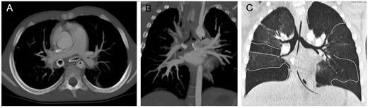 Computed tomographic angiography in Patient 3. (A) Axial and (B) coronal plane, maximum intensity projection reconstructions: the stent in the left mainstem bronchus completely ruptured (black arrow), the subcarinal space filled with fibrous peribronchial tissue (area enclosed by the continuous white line) and the stent in the right mainstem bronchus patent. (C) Coronal minimum intensity projection reconstruction: mosaic pattern of the lung parenchyma characterized by air trapping (area enclosed by the continuous line). The descending aorta (*) and left pulmonary artery (°).