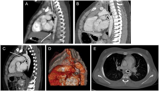 Computed tomographic angiography (CTA) in Patient 4. Pre-stent (A) and post-stent (B) sagittal multiplanar coronal reconstruction. Adequate space between the left mainstem bronchus (A, black arrow) and the vascular structures before stenting. (B) Segmental bronchial narrowing (black arrow) and peribronchial fibrous tissue (area enclosed by the dotted line). The descending aorta (*) and left pulmonary artery (°). Sagittal multiplanar (C) and 3D reconstruction (D) and axial (E) plane CTA. The bronchus is stapled between the left pulmonary artery and the hystmic aorta because of the traction of the ligamentum arteriosus (white arrow on C). Abundant peribronchial fibrous tissue between the aorta, the roof of the left atrium and the bronchus.