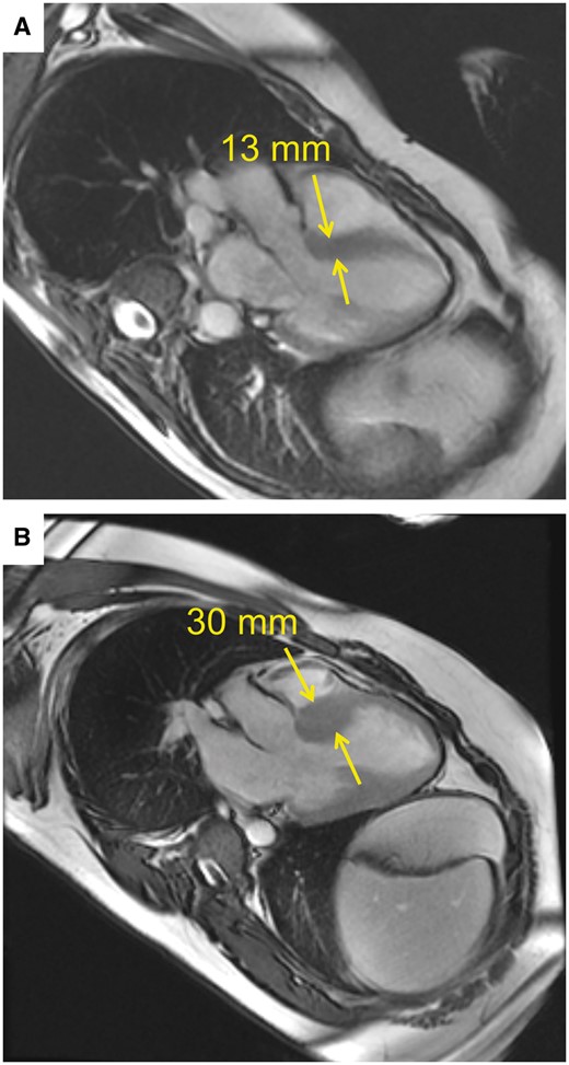 Preoperative cardiac magnetic resonance imaging in 2 patients. (A) Basal septal thickness measured 13 mm in the first patient. (B) Basal septal thickness measured 30 mm in the second patient. Yellow arrows mark where measurements were taken.