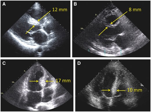 Preoperative and postoperative long-axis transthoracic echocardiography (TTE) in 1 patient (A, B) and preoperative and postoperative 4-chamber TTE in another patient (C, D). (A) Preoperative basal septal thickness of 12 mm. (B) Markedly reduced septal thickness of 8 mm postoperatively. (C) Preoperative basal septal thickness of 17 mm. (D) Markedly reduced septal thickness of 10 mm postoperatively. Yellow arrows mark where measurements were taken.